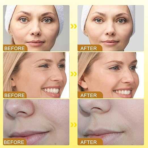 Botox Bee Venom Cream Buy 1 Get 1 Free